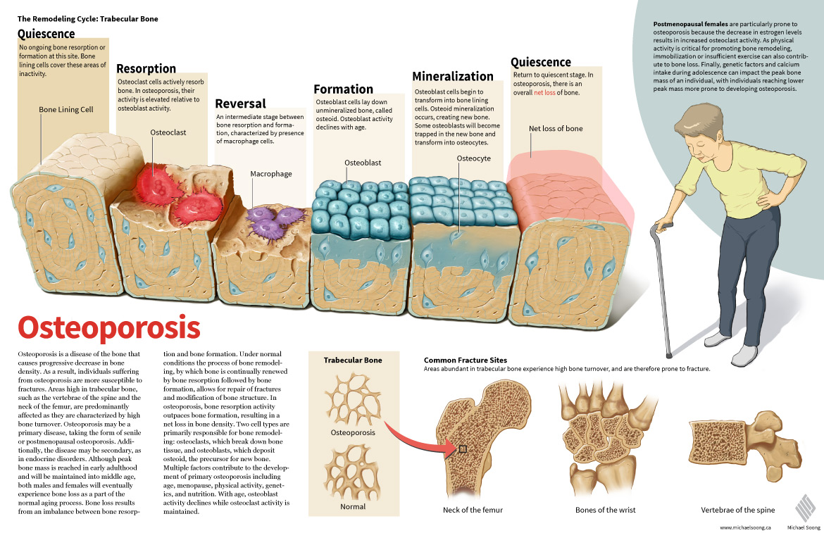 Osteoporosis