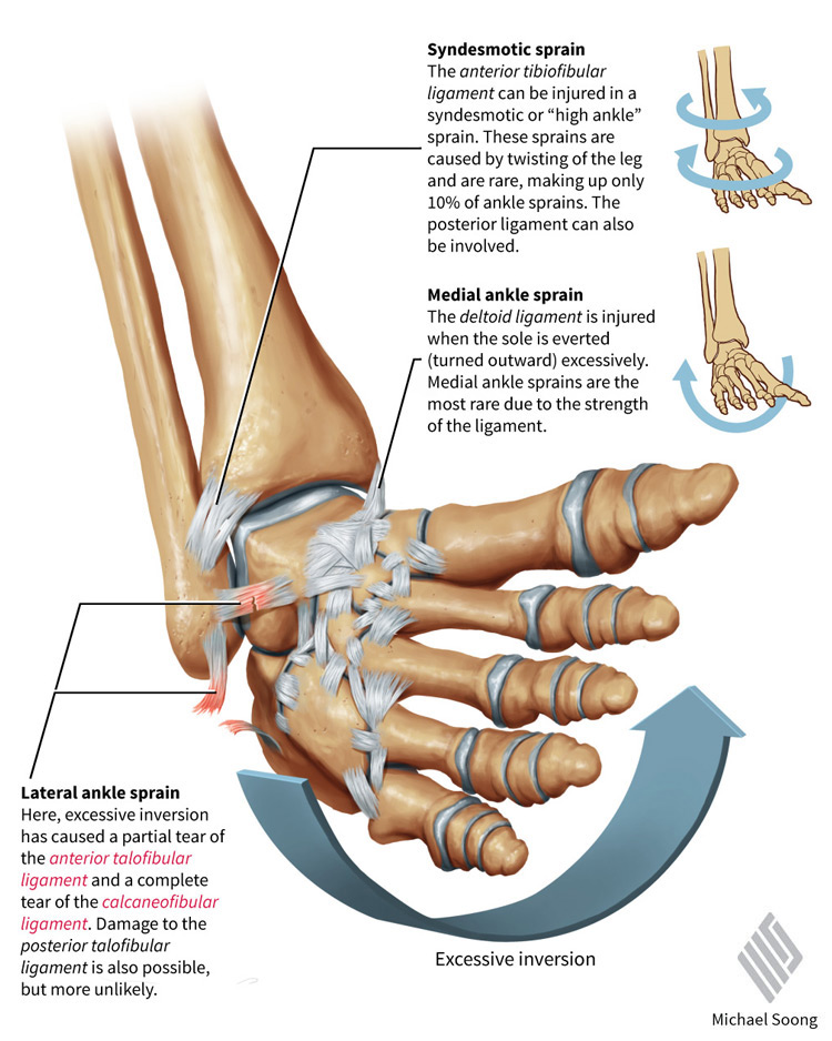 Michael Soong Basketball Injuries 3