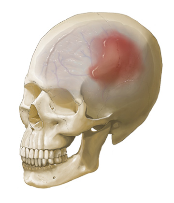 Michael Soong Epidural Hematoma