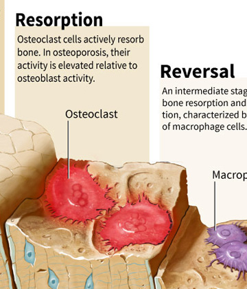 Michael Soong Osteoporosis